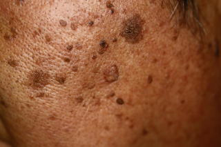 2490老人 性 イボ かゆい 処理